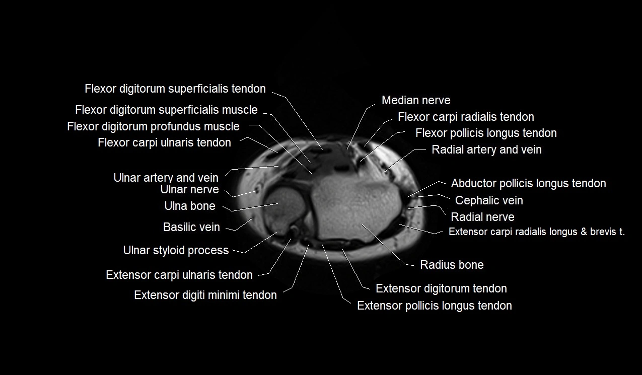 MRI 3T forearm axial cross sectional anatomy image 44.webp